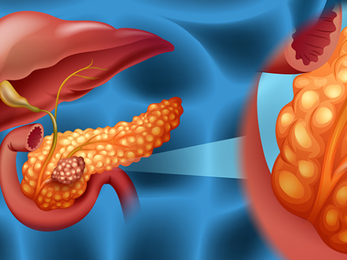 Novo exame de sangue pode ajudar na detecção precoce do câncer de pâncreas