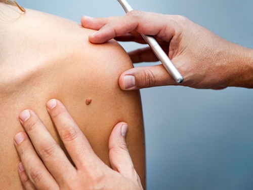 Oncologistas alertam para riscos de câncer de pele