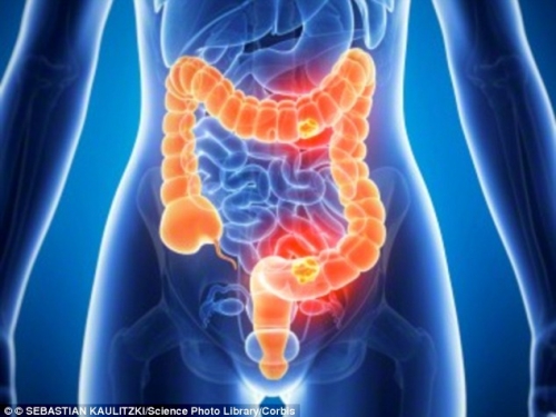 Campanha de prevenção ao câncer de intestino tem início