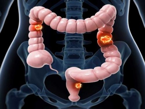 CAS debaterá dificuldades de tratamento do câncer colorretal
