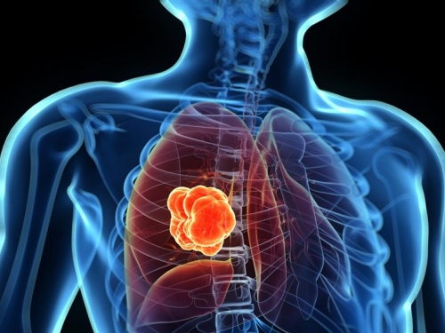 Atualização do Rol da ANS melhora tratamento do câncer de pulmão
