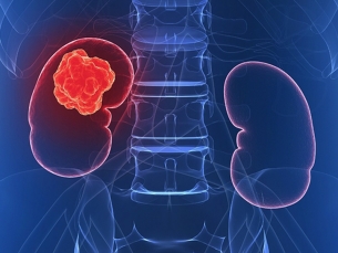 Mais de 90% dos casos de câncer renal evoluem para metástase