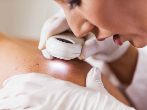 Quase 80% dos brasileiros desconhecem o tipo de câncer de pele mais mortal