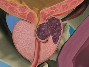 Prevenção contra o câncer de próstata deve se transformar em rotina a ser seguida