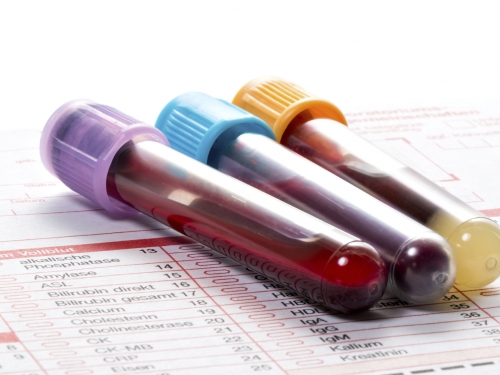 Um exame de sangue que detectaria precocemente diferentes tipos de câncer