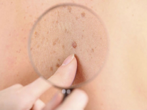 Câncer de pele melanoma: como prevenir e diagnosticar precocemente