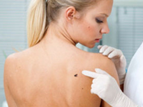 Mitos e verdades sobre o câncer de pele, tipo da doença mais comum no país
