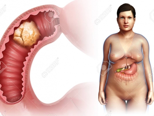 Quando realizar exames para detecção de câncer no intestino?