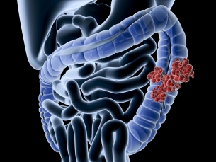 Fique atento aos sinais do corpo que podem indicar o câncer do intestino