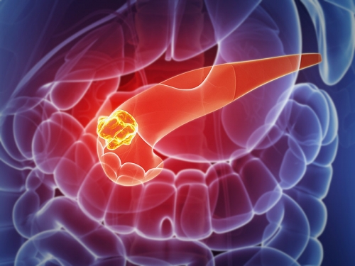 Novo tratamento para câncer de pâncreas começa a ser testado em humanos nos EUA