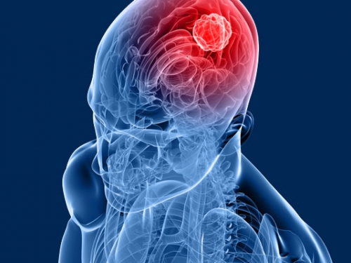 Saiba quais são os sintomas de câncer no cérebro