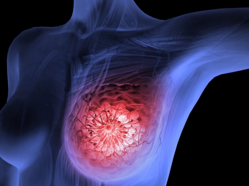 Promessa dos biossimilares no tratamento do câncer de mama