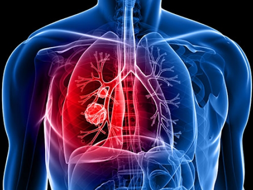Radioterapia ultrapotente é testada em câncer de pulmão para evitar cirurgia