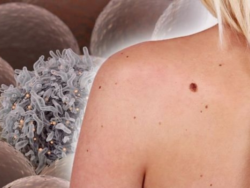 Dezembro Laranja: como identificar os primeiros sinais do câncer de pele?