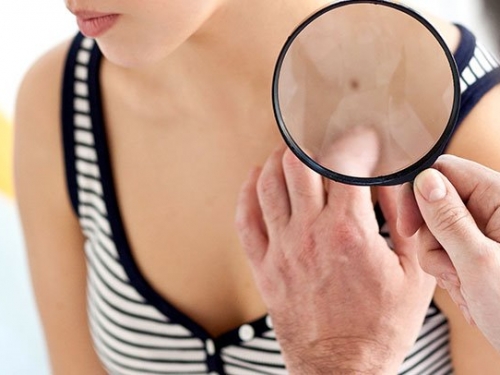 5 mitos sobre o câncer de pele