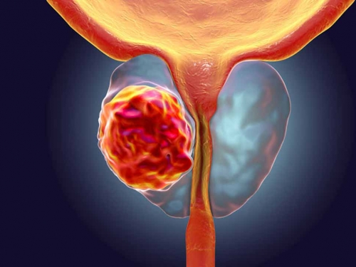 Câncer de próstata ainda é uma das principais causas de mortes entre homens