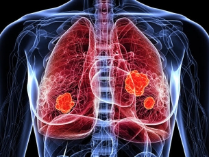 Xalkori (crizotinibe): um medicamento indicado para o tratamento de câncer no pulmão
