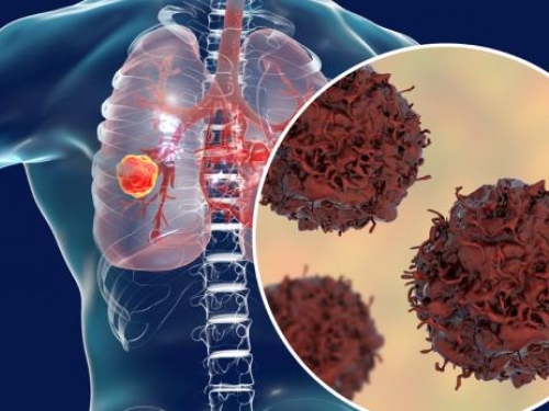 Diagnóstico precoce do câncer de pulmão aumenta chances de cura para 90%
