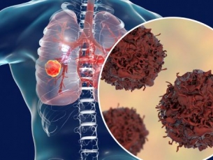 Diagnóstico precoce do câncer de pulmão aumenta chances de cura para 90%