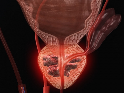 Medicamento contra colesterol é eficaz em caso de câncer de próstata