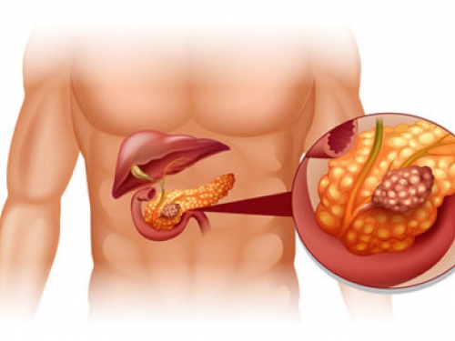 Proteína associada à sobrevivência celular tem ligação com câncer de pâncreas