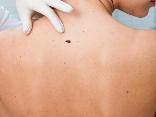 Vacina contra o melanoma começa a ser testada em humanos